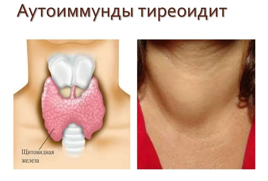 Диффузное изменение щитовидной железы аит. Аит зоб щитовидной железы. щитовидная железа болезнь хашимото. аутоиммунные заболевания щитовидной железы тиреоидит. болезнь хашимото (аутоиммунный тиреоидит).