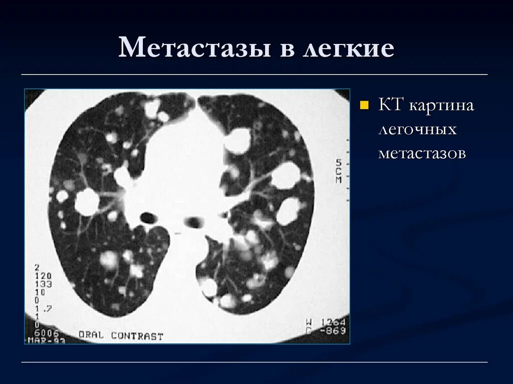 Множественные округлые. Кт легких метастазы в легкие. Лимфогенные метастазы кт.