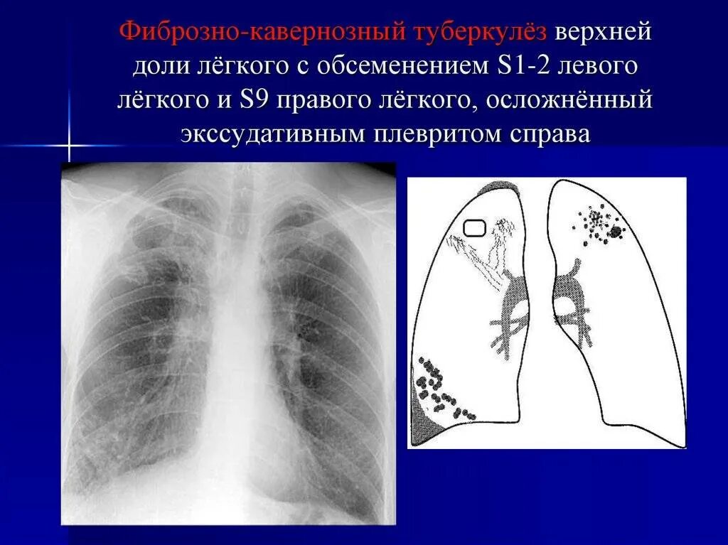 Инфильтративный туберкулез легких s1 s2. Инфильтративный туберкулез рентген. Фиброзно-кавернозный туберкулез рентген. Инфильтративный туберкулез легкого.