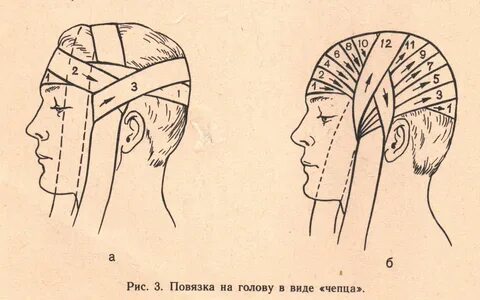 Правильное наложение повязки чепец