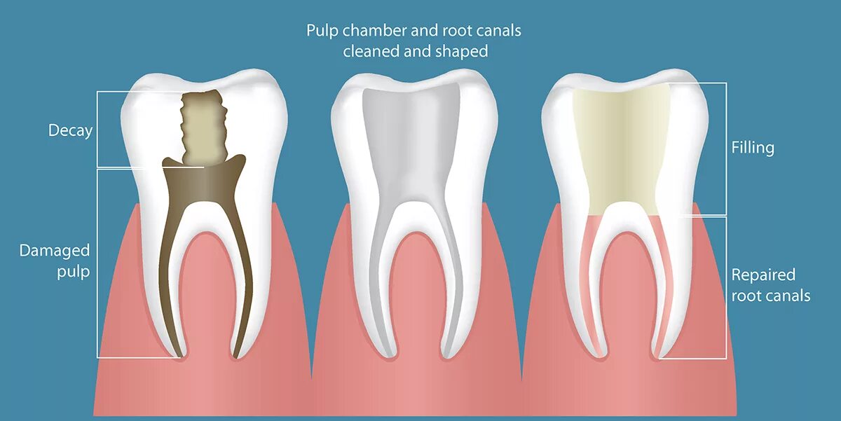 Root canal. Пломбирование каналов зубов. Перелечивание каналов зуба. Перепломбировка каналов зуба.