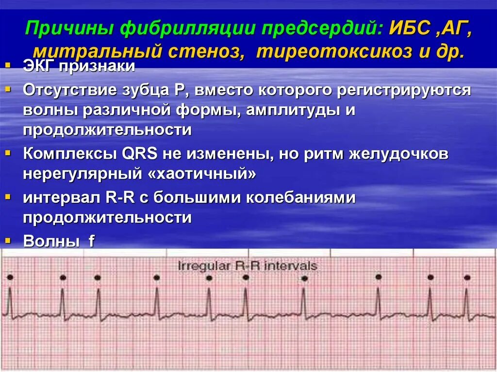 Тахисистолия это. Фибрилляция предсердий Мерцательная аритмия ЭКГ. Пароксизмальная фибрилляция предсердий на ЭКГ. Мерцательная аритмия на ЭКГ пароксизмальная форма. Пароксизмальная форма фибрилляции предсердий ЭКГ.