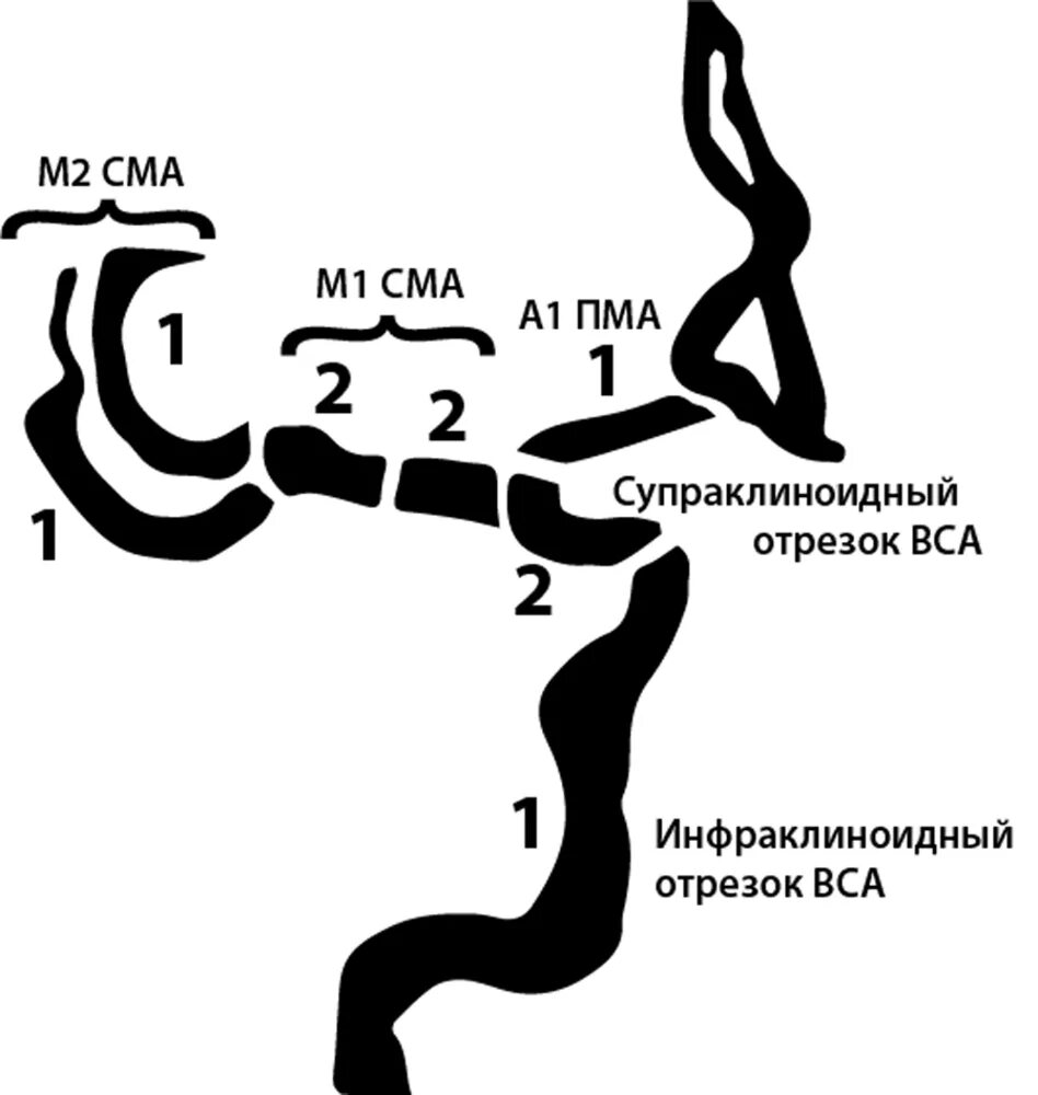 Сегменты средней мозговой артерии на кт. Сегменты сонной артерии схема. Сегменты средней мозговой артерии на кт схема. Сегменты внутренней сонной артерии мрт. Сегмент а1 пма