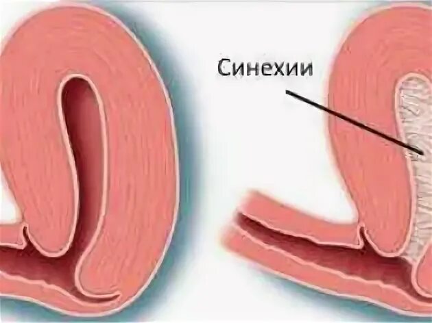 Синехии в мочеиспускательном канале. Синехии половых губ у детей. Сросшиеся малые половые губы.