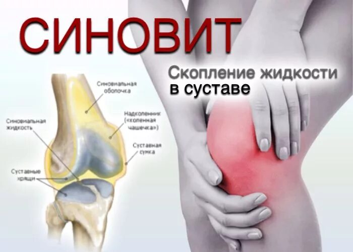 Жидкость в коленном суставе