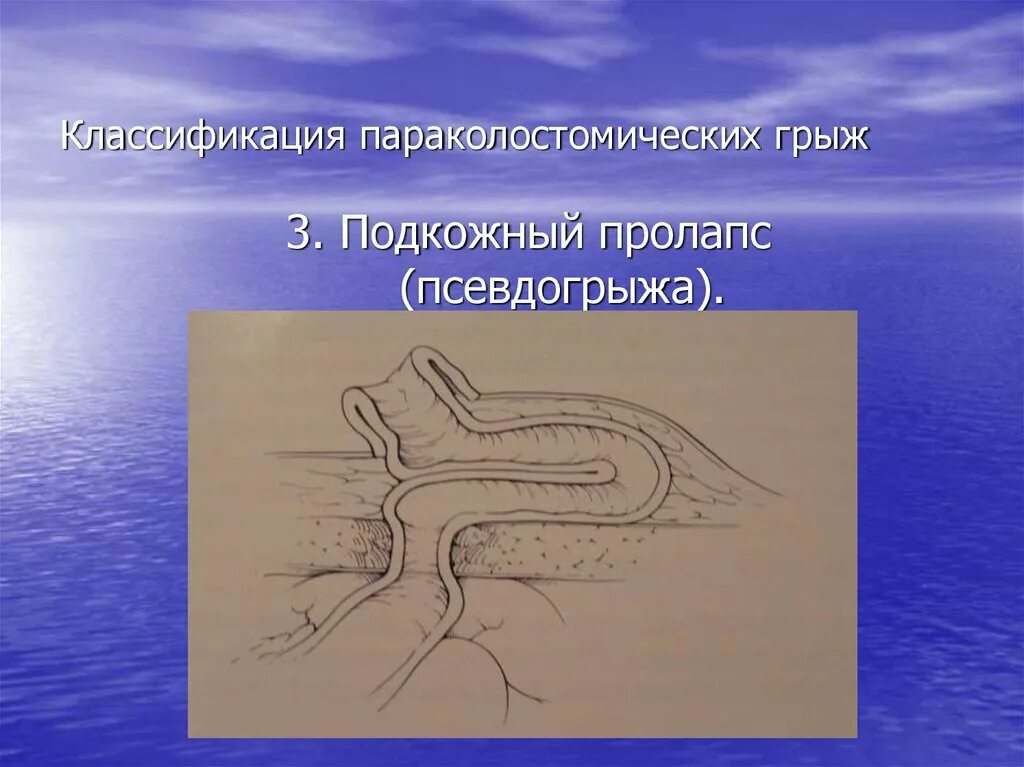 Ущемленная грыжа код по мкб 10. Классификация параколостомических грыж. Параколостомическая грыжа. Параколостомическая грыжа мкб. Параколостомическая грыжа операция.