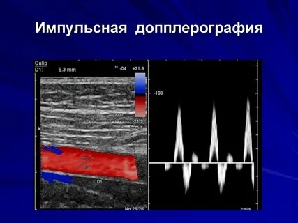 Спектральная допплерография