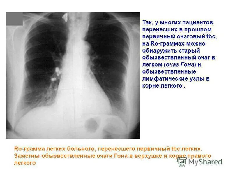 Очаговых изменений правого легкого. Очаговый туберкулез очаг гона рентген. Очаг гона на рентгенограмме.