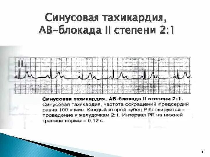 Предсердная блокада. Предсердная тахикардия с АВ блокадой 2:1. Атриовентрикулярная блокада 2 степени ЧСС. Синусовый ритм АВ блокада 2 степени. Синусовая блокада 2 степени ЭКГ.