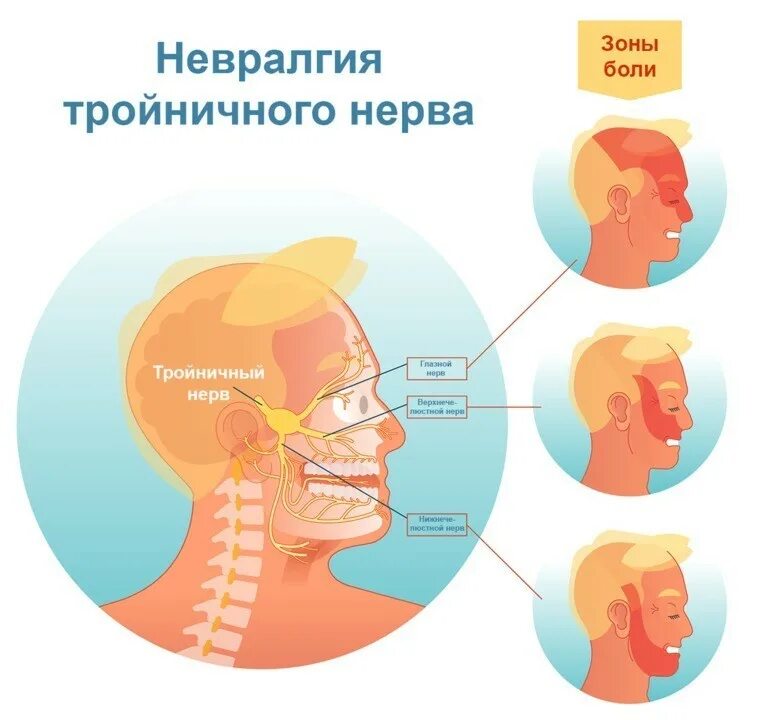 Ноющая боль в лице. Воспаление тройничного нерва симптомы. Невралгия тройничного нерва 1. Оспалениетройничного нерва. Тройничный нерв восполен.