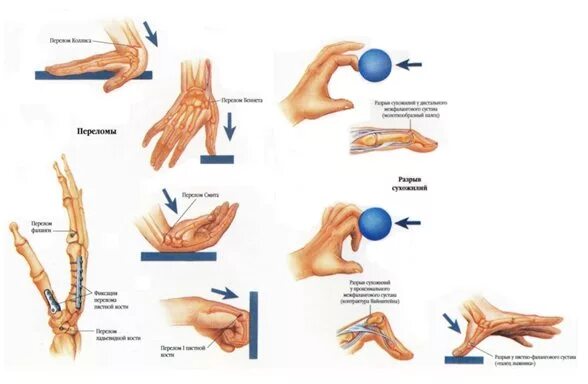 Контрактура сустава лучезапястного перелом. ЛФК для лучезапястного сустава. Контрактура сустава кисти после перелома. Гимнастика для кистей рук и пальцев после перелома. Лфк лучезапястного сустава после перелома со смещением