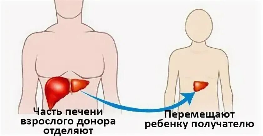 Трансплантация печени. Трансплантация части печени. Можно ли пересадить печень