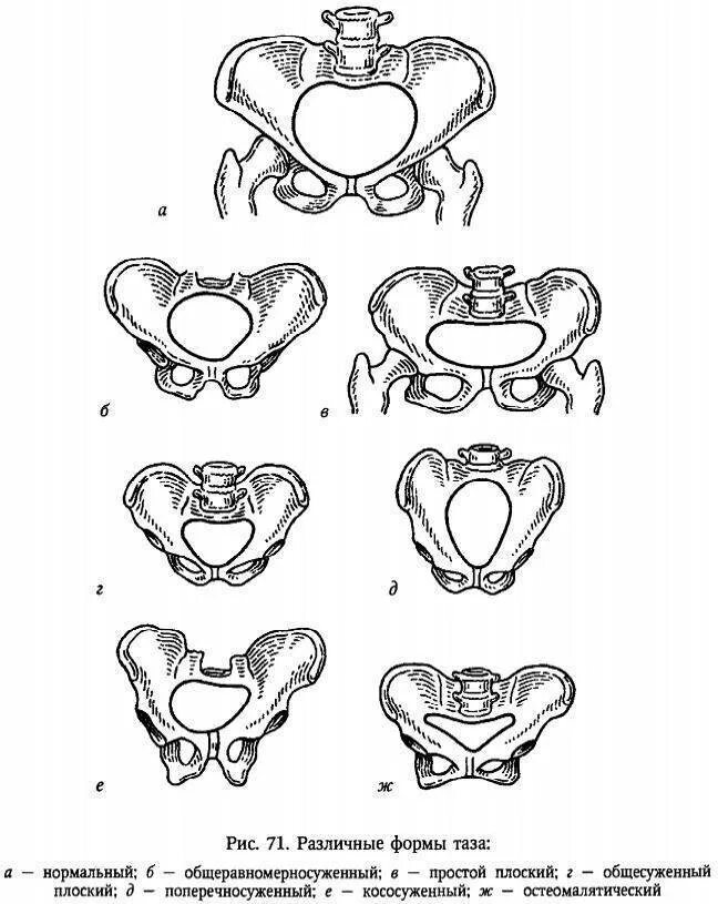 Сужения таза в акушерстве. Женский таз с акушерской точки. Расширенный таз. Расширенный таз. Расширенный таз.