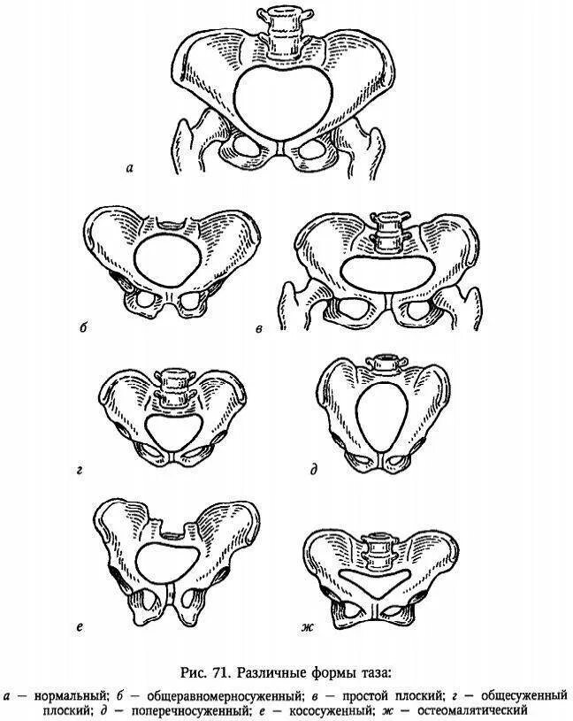 Кесарево узкий таз. Классификация узкого таза Акушерство. Узкий таз при беременности. Аномалии костей таза Акушерство. Широкий и узкий таз Акушерство.