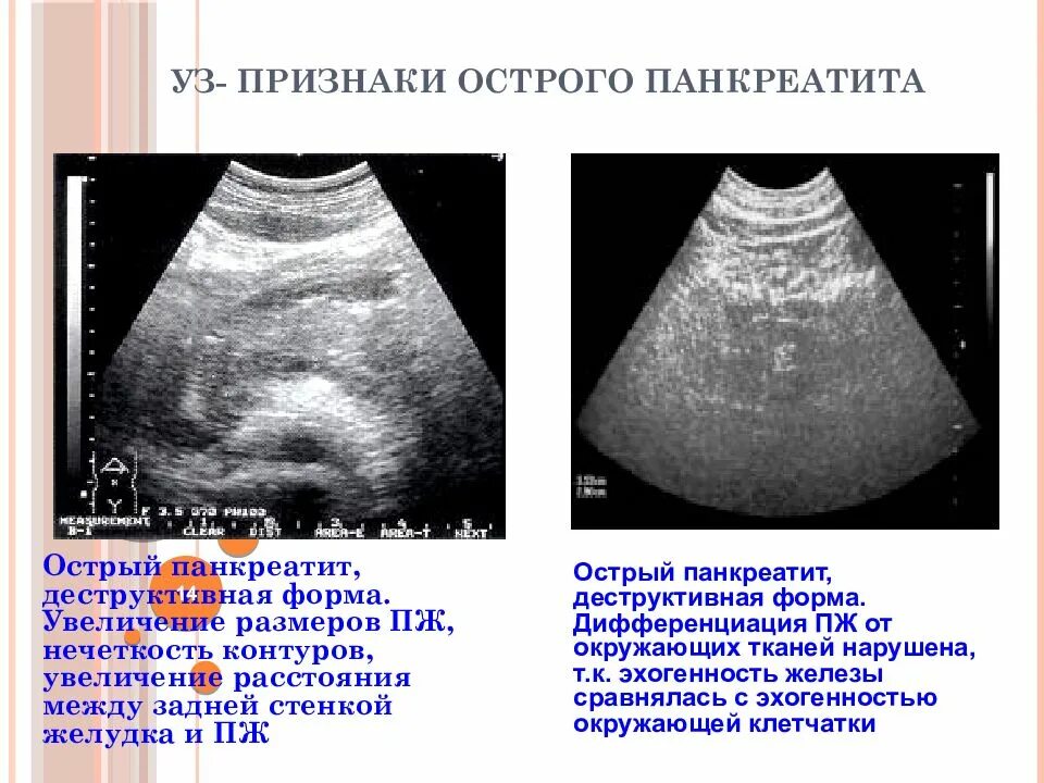 Острый деструктивный панкреатит. Признаки острого панкреатита. Панкреатит симптомы. Деструктивные формы панкреатита.