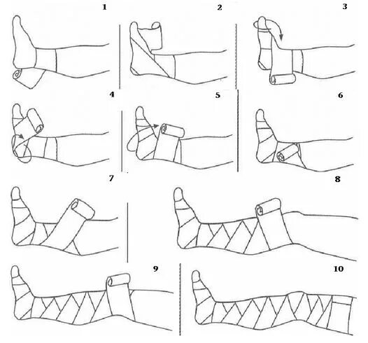 Эластичное бинтование ноги. Бинтование эластичным бинтом при варикозе. Эластическое бинтование нижних конечностей. Как правильно забинтовать ногу эластичным бинтом. Эластичное бинтование нижних конечностей.