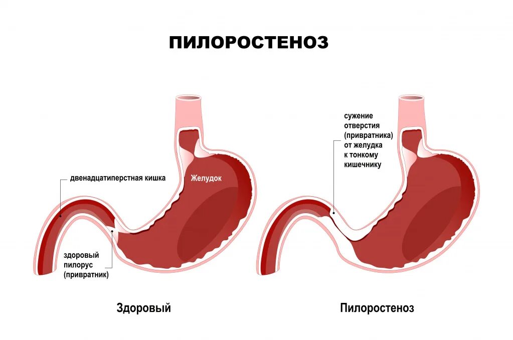 Кто такой привратник. Пилоростеноз привратника. Гипертрофический пилорический стеноз. Врожденный пилорический стеноз.