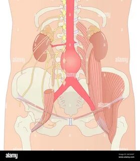 Abdominal aortic aneurysm