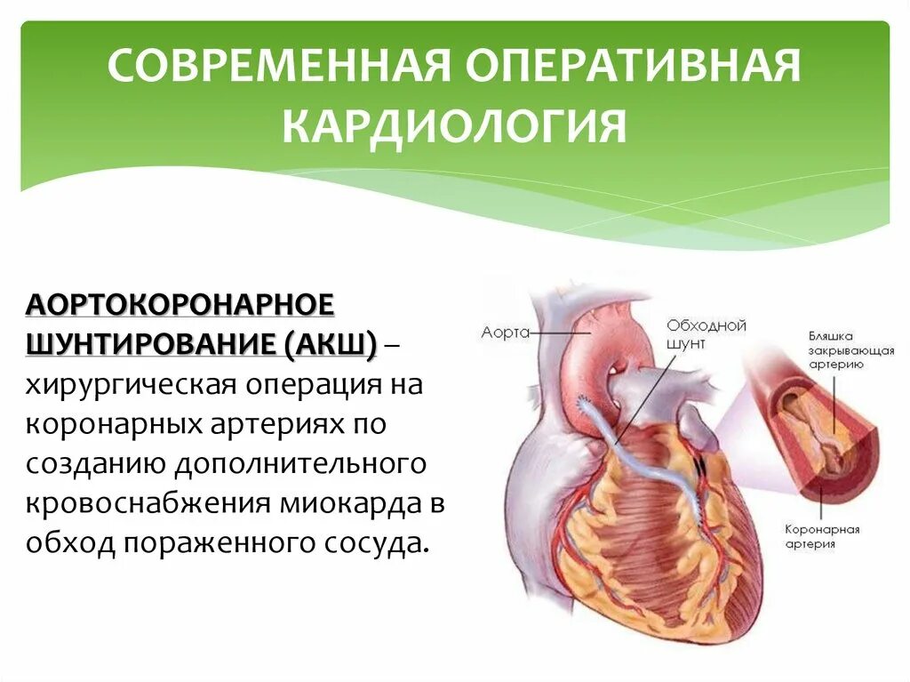 Инфаркт миокарда операция шунтирование. Хирургические методы лечения инфаркта миокарда. Аорто-коронарное шунтирован. Современная Оперативная кардиология. Как делают коронарное шунтирование