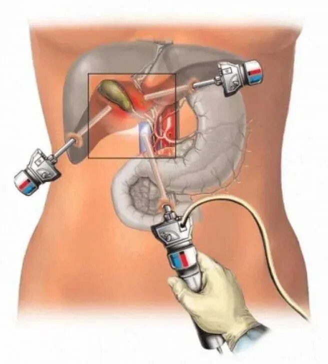 После удаления желчного пузыря. Операция лапароскопическая холецистэктомия. Холецистэктомия лапароскопия. Лапароскопия диагностическая ЖКБ. Лапароскопия камней желчного пузыря.