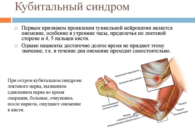 Туннельные нейропатии локтевой нерв. Кубитальный туннельный синдром. Синдром кубитального канала локтевого нерва операция. Запястный синдром компрессии локтевого нерва.