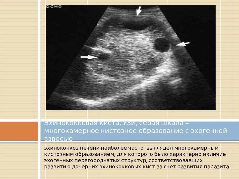 Что значат кисты на печени. Эхинококковая киста на УЗИ. Эхинококковая киста печени УЗИ. Киста поджелудочной железы на УЗИ. Эхинококкоз печени УЗИ.