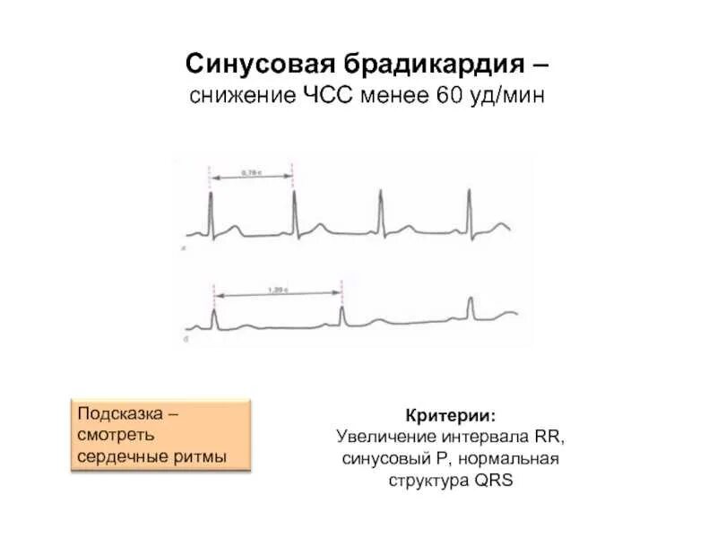 Брадикардия как поднять пульс. Синусовая брадикардия на экг. экг брадикардия синусовый ритм. экг при брадикардии. что такое синусовая брадикардия с чсс 59 уд/мин.