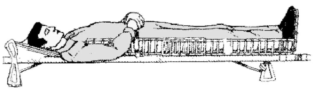 Шина при травме головы. Иммобилизация переломов Крамера. Иммобилизация шиной Дитерихса. Шина Крамера при переломе позвоночника. Иммобилизация при переломе бедра.