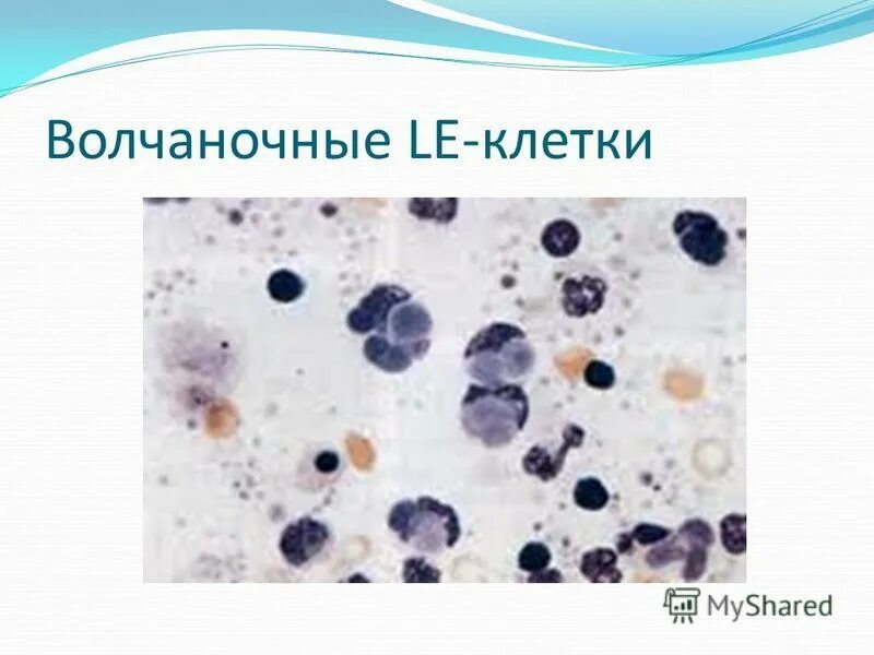 исследование феномена "клетки красной волчанки". волчаночные клетки это. волчаночные клетки это. волчаночные клетки это. волчаночный клетки.