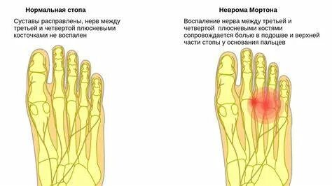 Неврома мортона что это причины