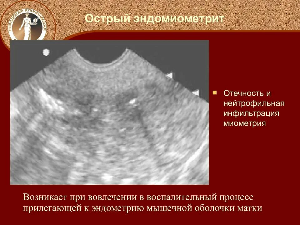 Послеродовый эндометрит. Эндомиометрит (метроэндометрит). Послеродовый эндометрит УЗИ матки.