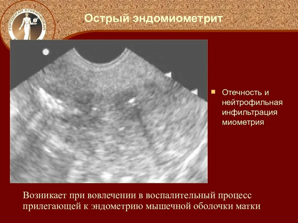 Эндометрии в полости. Послеродовый эндометрит. Эндомиометрит (метроэндометрит). Послеродовый эндометрит УЗИ матки.