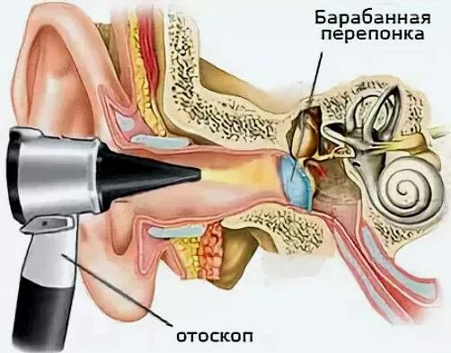 Экссудативный отит перепонка. Экссудативный отит барабанная перепонка. Экссудативный отит шунт. Перфорация барабанной перепонки.