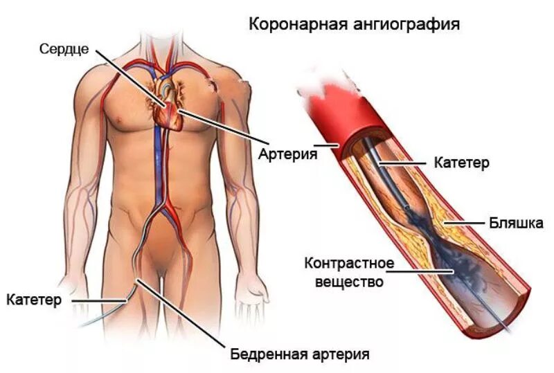 Синяк после стентирования