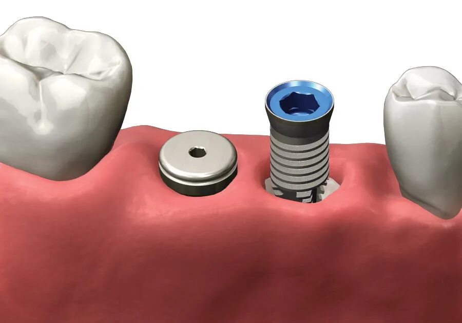 Заглушка для винтов tx20. Импланты осстем без заглушки. Заглушка astra tech. Абатмент заглушка формирователь. Зубной имплантат с заглушкой.