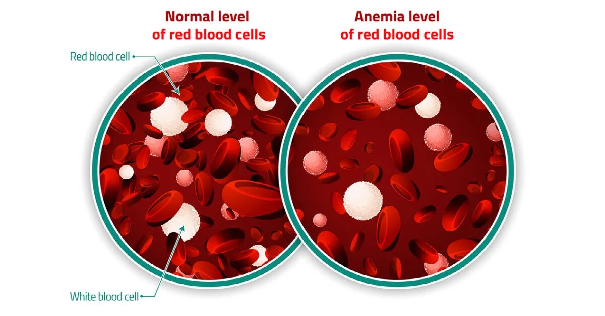 Анемия стул. Анемия эритроциты. Эритроциты в крови анемия. Эритроциты при анемии.