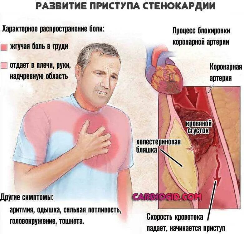 Боли при болезни легких. Острая коронарная недостаточность симптомы. Синдром острой коронарной недостаточности симптомы. Приступ стенокардии.