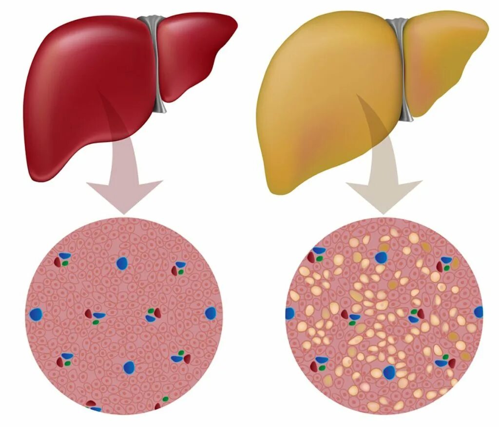 Печень больная жировой. Жировой гепатоз печени острый. Жировой стеатоз печени. Стеатоз печени дистрофия. Жировой гепатоз (стеатоз) печени.