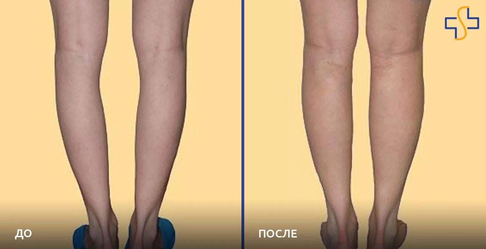 Круропластика ног. Хронический лимфостаз лимфедема. Круропластика голени асимметрия голени. Круропластика (пластика голеней) что это.