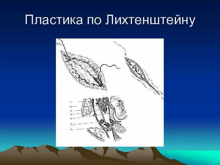 Безнатяжная пластика по лихтенштейну. Операция герниопластика. Пластика грыжи по бассини. Пластика по лихтенштейну при паховой. Пластика по лихтенштейну при паховой.