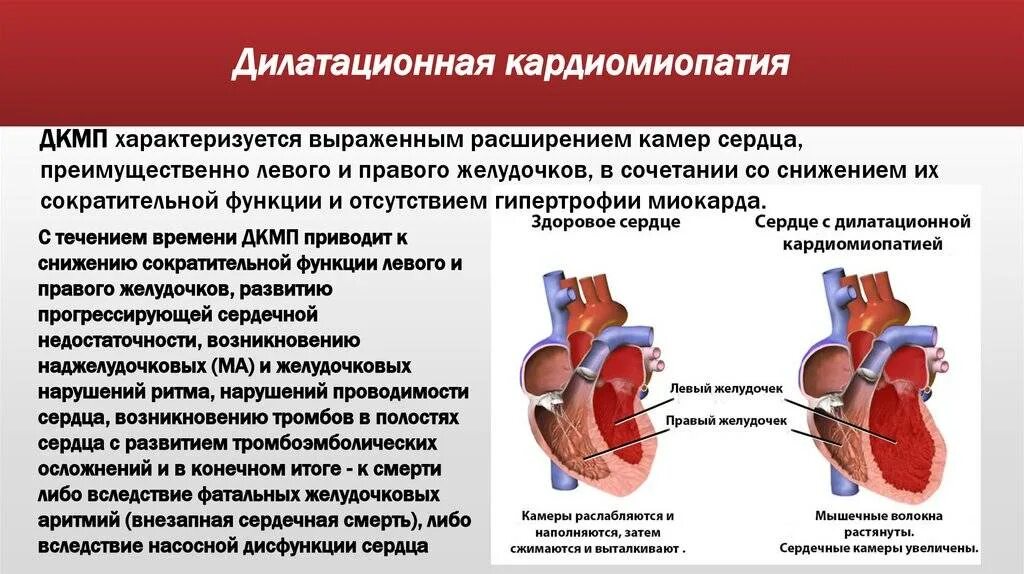 Сердечная декомпенсация это. Левожелудочковая недостаточность и дилатационная кардиомиопатия. Гемодинамика при дилатационной кардиомиопатии. Dilatasiyon kardiomiopatiya. Симптомы дилатационной кардиомиопатии.