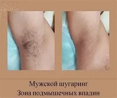 Мужской шугаринг. Шугаринг для мужчин подмышки. Шугаринг мужской зоны подмышек. Видео мужского шугаринга глубокого