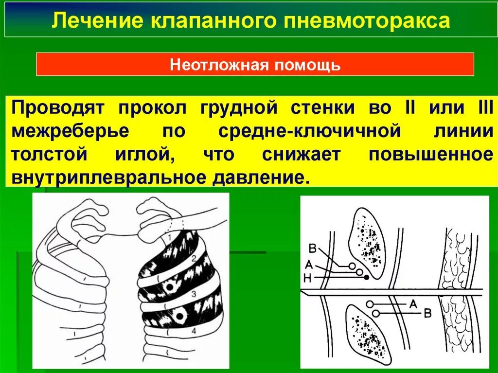 Напряженный пневмоторакс помощь. Первая помощь при клапанном пневмотораксе. Клапанный пневмоторакс. При клапанном пневмотораксе. Коапанныы спонтанвц пневмотор.