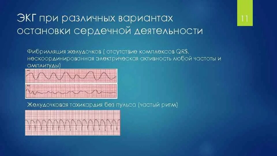 Желудочковая тахикардия без пульса на ЭКГ. Электрическая активность сердца без пульса на ЭКГ. Электромеханическая диссоциация на ЭКГ. Желудочковая тахикардия и фибрилляция желудочков.