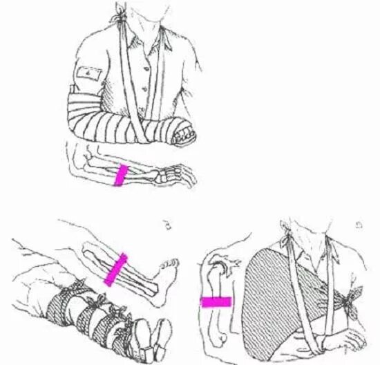 1 помощь при переломе верхней конечности. Закрытый перелом конечности первая помощь. Первая помощь при закрытом переломе конечностей. Первая врачебная помощь при закрытом переломе. Фиксация конечностей при переломах.