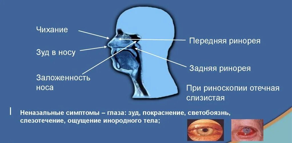 Симптомы заложенность носа без насморка. Аллергический ринит симптомы. Симптомы аллергического ринита. Аллергический ринит симптомы у взрослых.