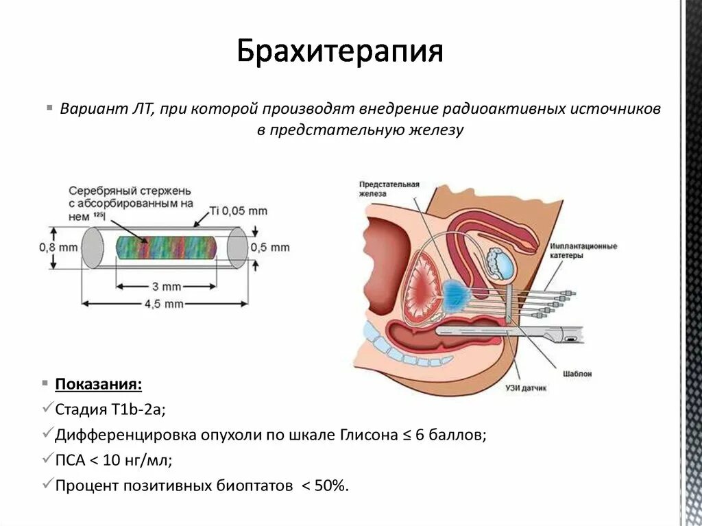 Брахитерапия предстательной железы. Низкодозная брахитерапия. Брахитерапия предстательной железы низкодозная. Дифференцировка опухолей предстательной железы. Брахитерапия простаты цена