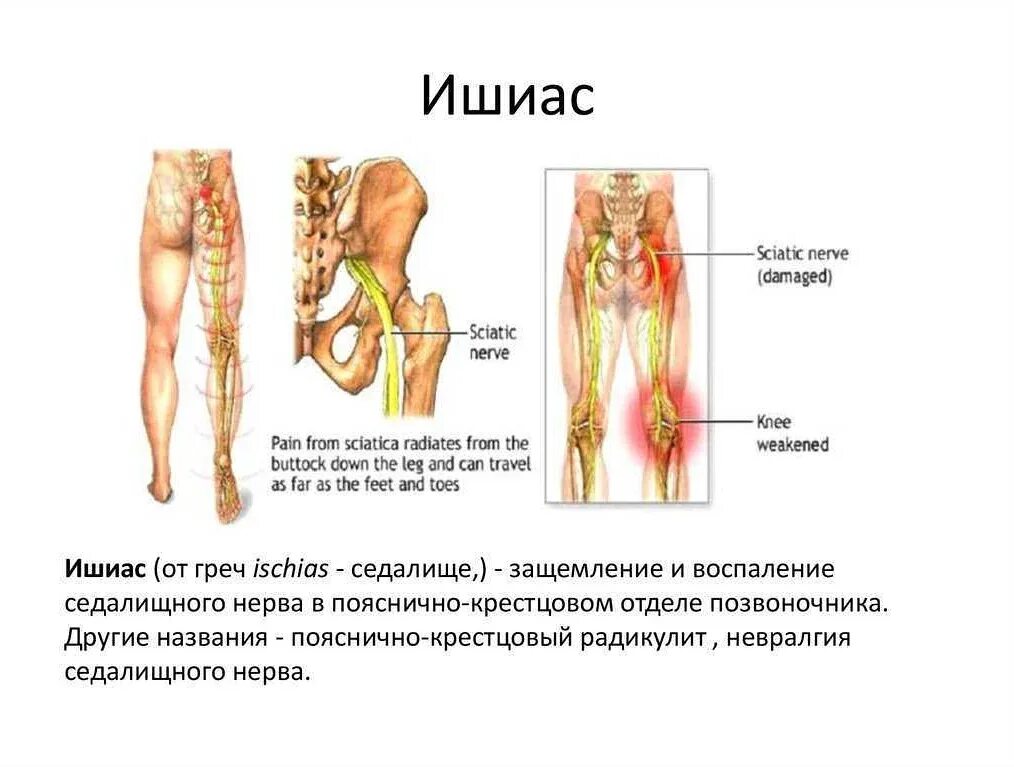 Анатомия. Седалищный нерв в ягодице. Седалищный нерв анатомия функции. Схема защемления седалищного нерва. Ущемление седалищного нерва симптомы.