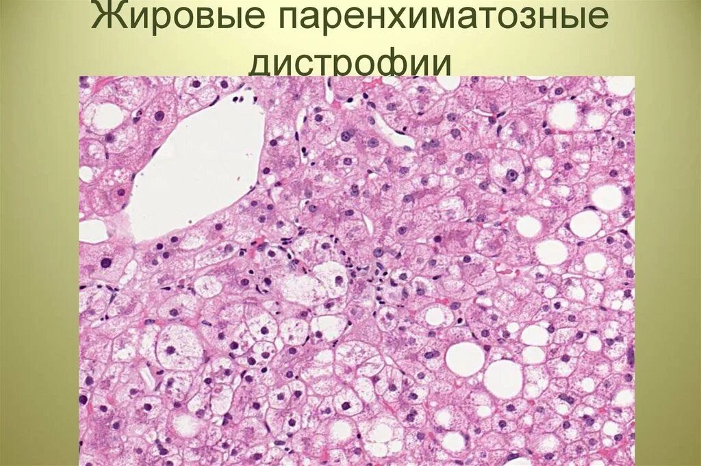 Паренхиматозные жировые дистрофии. Жировая дистрофия печени (липидозы). Паренхиматозная дистрофия печени. Клеточные жировые дистрофии.