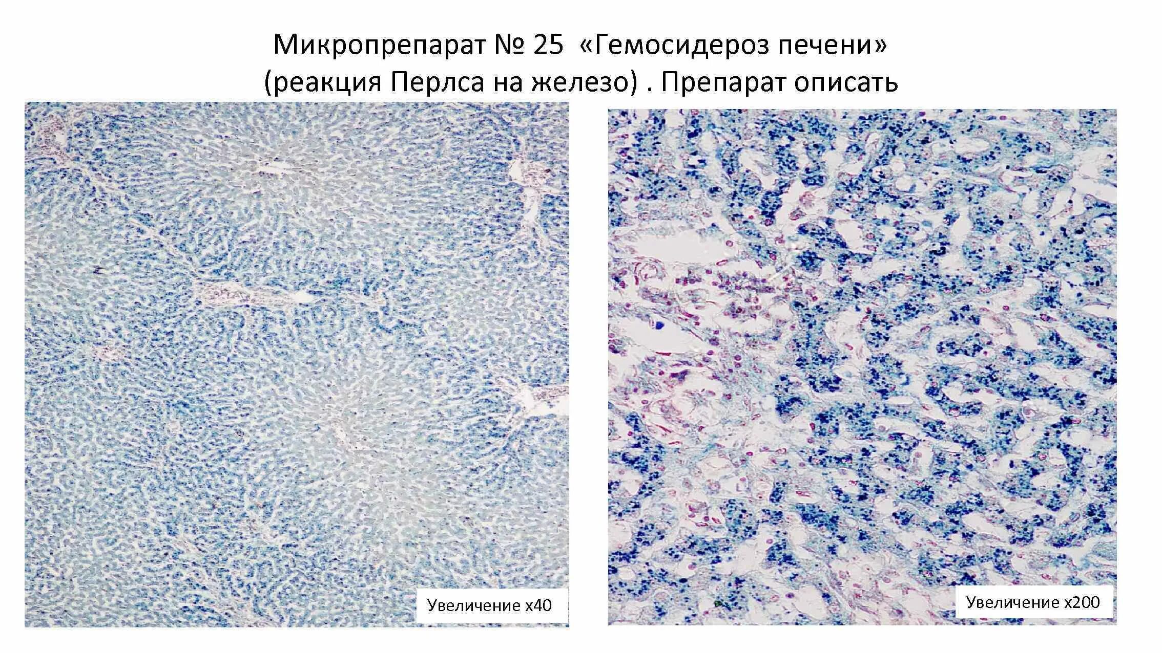 Печень микропрепарат описание. Дистрофия гемосидерин. Мускатная печень патанатомия. Смешанная дистрофия гемосидерин. Мускатная печень патологическая анатомия.